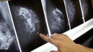 Aprovado PL que institui diretrizes para Exame de Mamografia Móvel